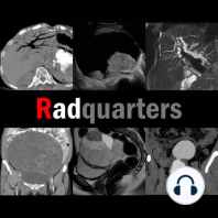 Imaging of Adrenal Adenomas & Incidentalomas