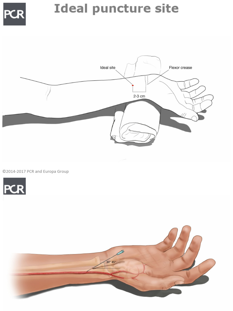 Radial Fundamentals Puncture FINAL | PDF