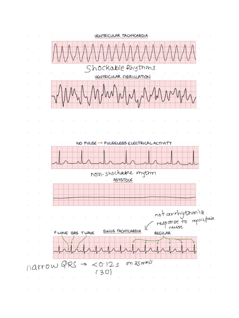 ECG Shortcuts | PDF