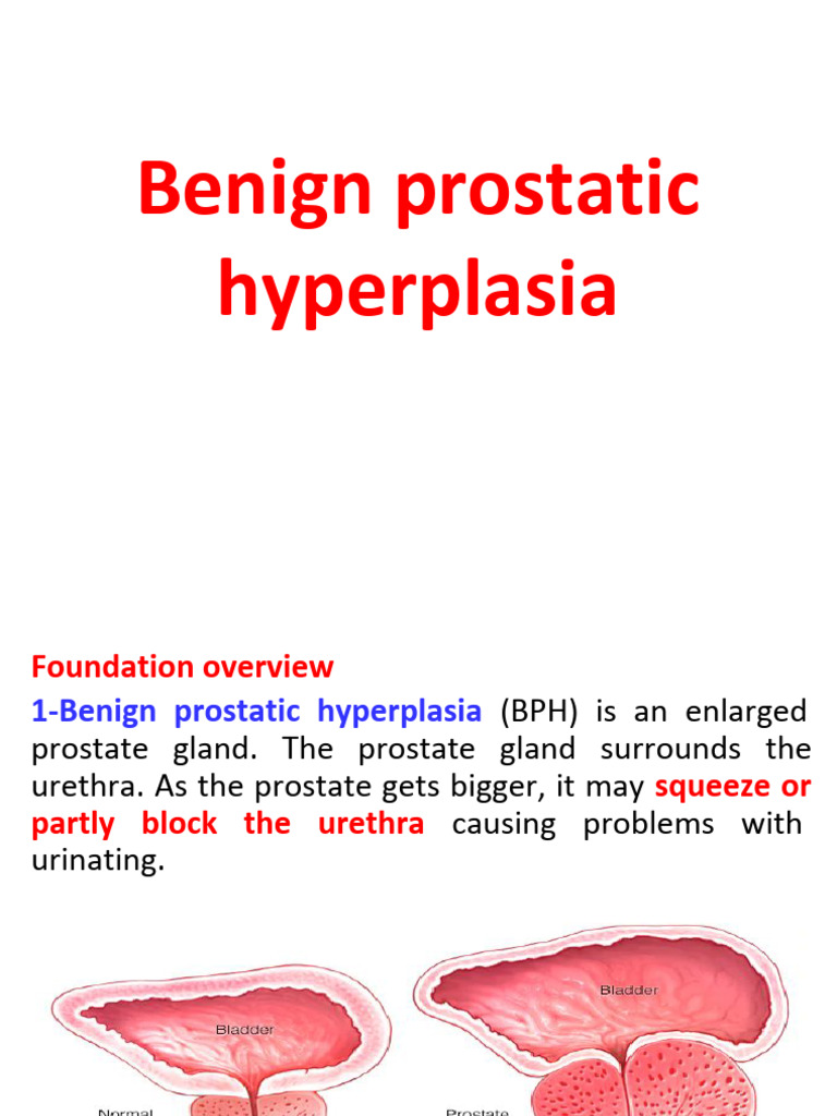 Lec.7 BPH | PDF | Urinary Incontinence | Prostate