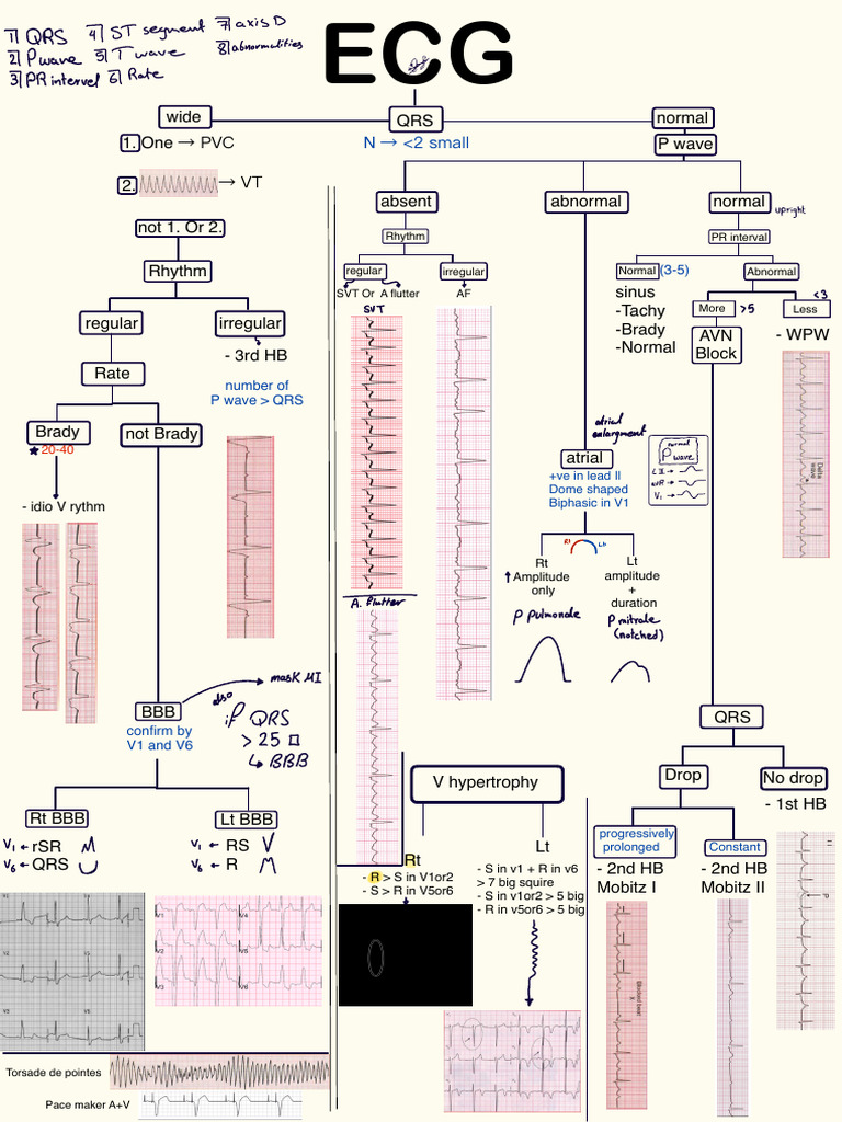 PVC VT: 2 Small | PDF | Electrocardiography | Internal Medicine