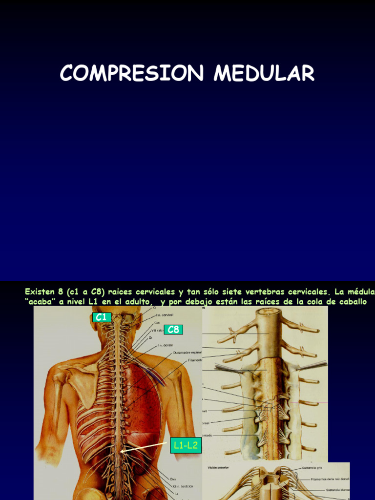 420-2014-02-25-02 Compresion Medular | PDF | Metástasis | Lesión de la ...