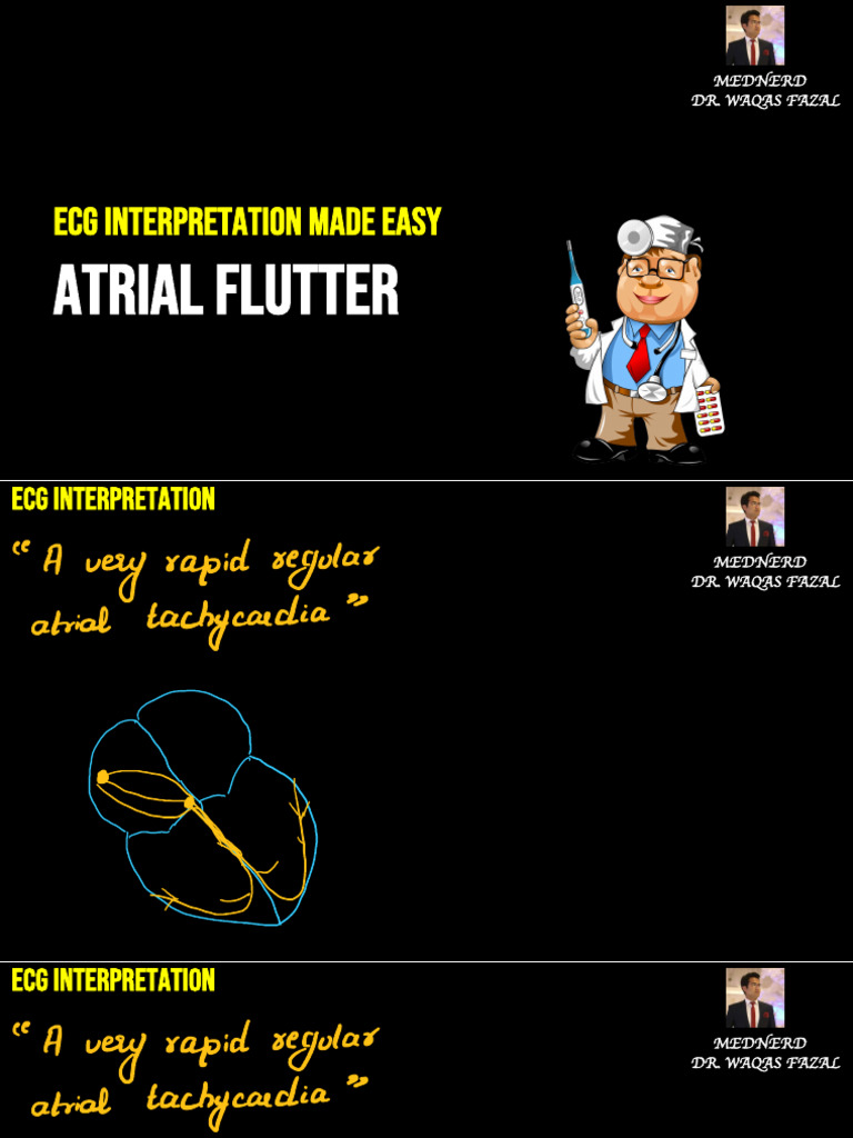 Atrial Flutter ECG Lecture 7 | PDF | Cardiac Arrhythmia | Physiology