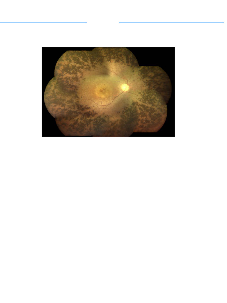 Retinitis Pigmentosa | PDF | Retina | Diseases And Disorders