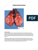 Papillary Thyroid Carcinoma