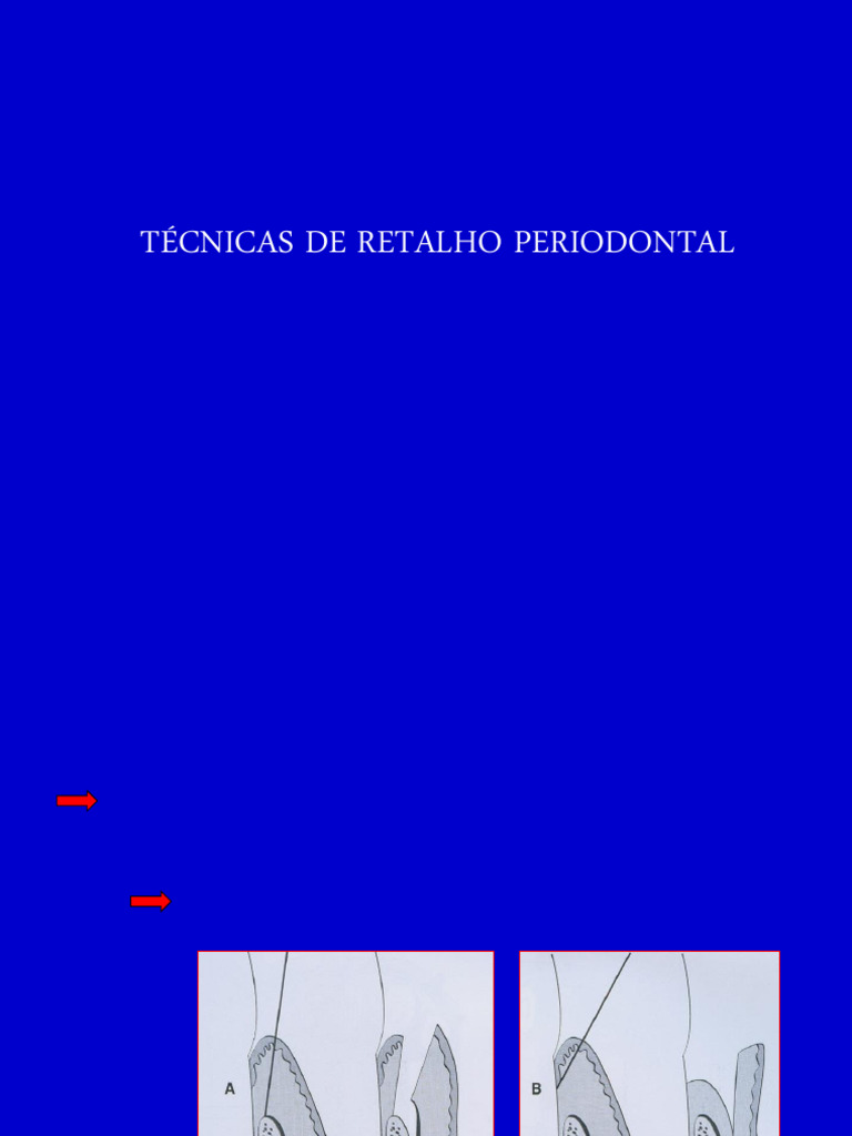 Cirurgia Periodontal Tipos de Retalho | PDF | Áreas da odontologia | Boca