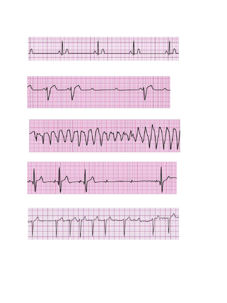 Ritmos ACLS | PDF