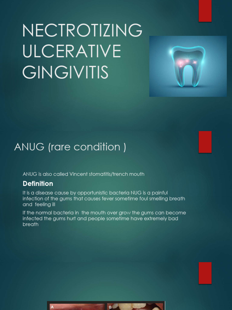 00ae90_nectrotizing Ulcerative Gingivitis | PDF
