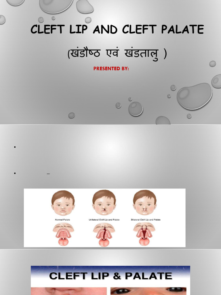 Cleft Lip and Cleft Palate | PDF | Diseases And Disorders | Human Anatomy
