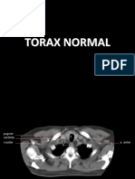 Torax Normal (