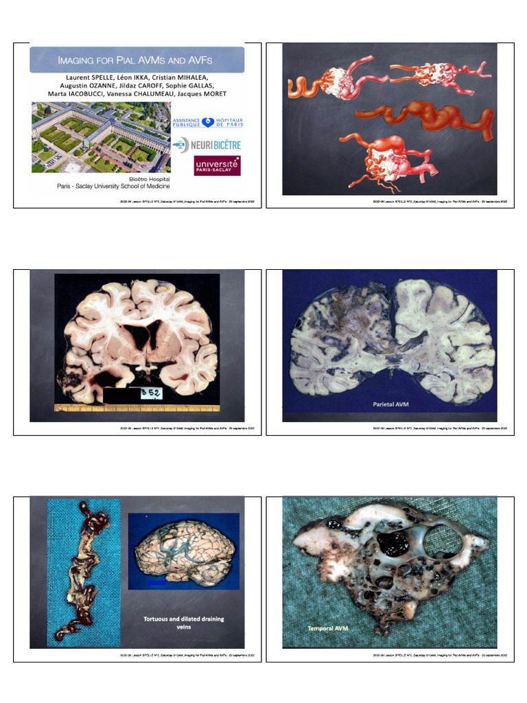 28418-Imaging For Pial AVMs and AVFs - Spelle | PDF