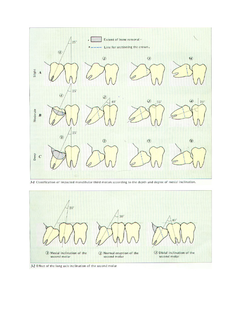 Wisdom Teeth Extraction | PDF