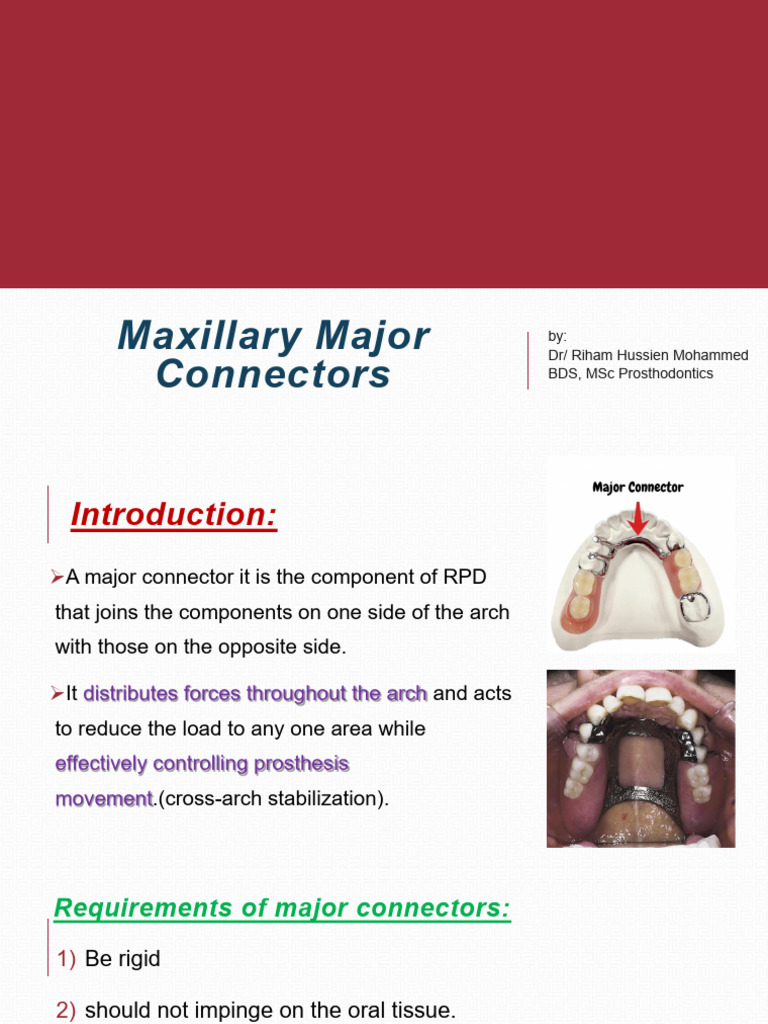 Maxillary Major Connector - 083720 | PDF