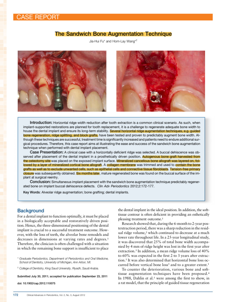 The Sandwich Bone Augmentation Technique | PDF | Dental Implant ...