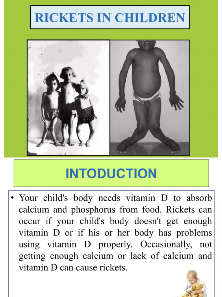 Rickets | PDF