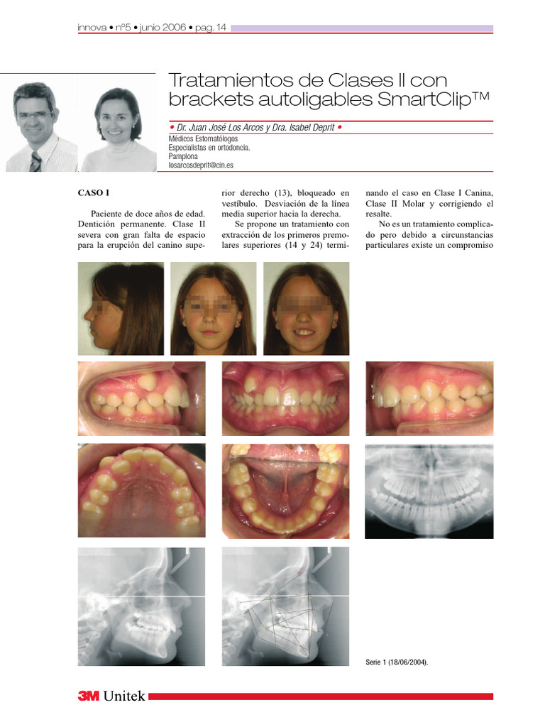 Tratamiento de Clase II Con Brackets Autoligables SmartClip. Revista ...