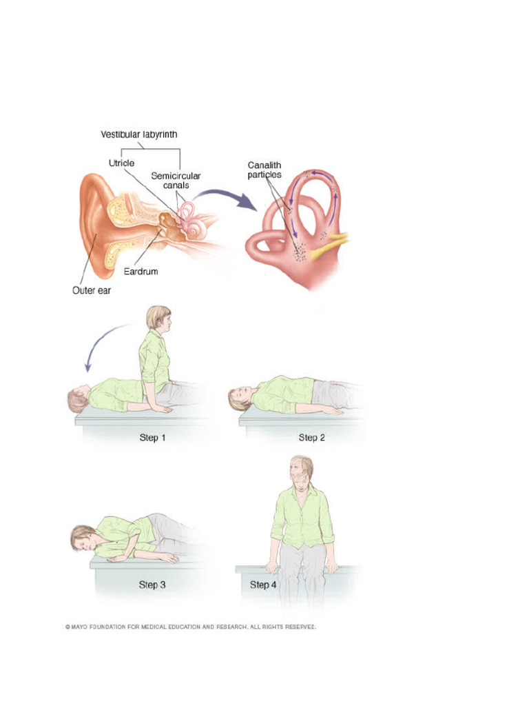 Canalith Repositioning Procedure | PDF