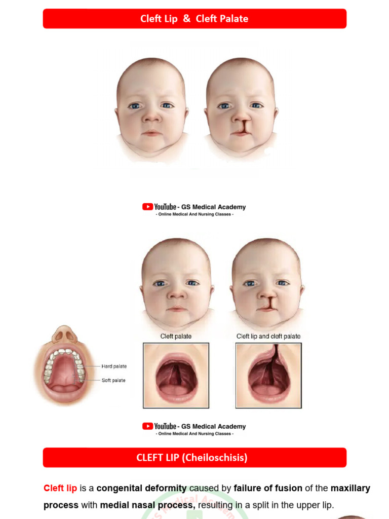 Cleft Lip & Cleft Palate | PDF