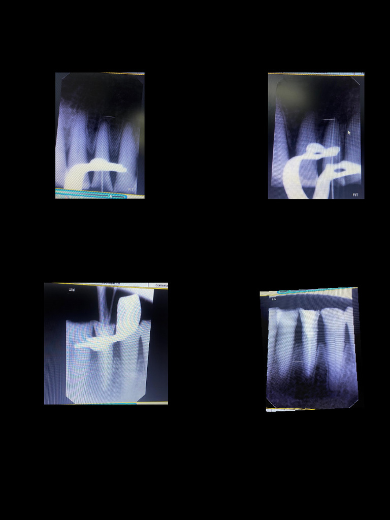 Endo 1 | PDF