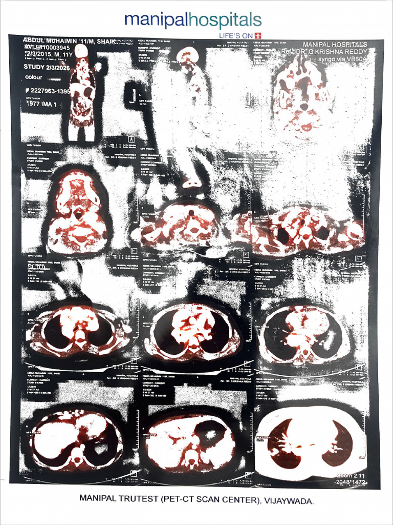 PET Scan | PDF