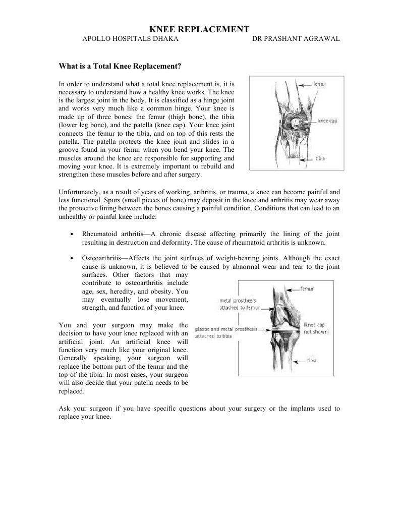 Total Knee Replacement Overview | PDF | Wellness