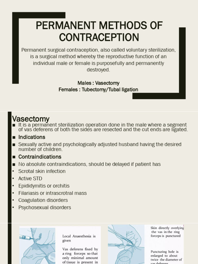 Permanent Methods of Contraception | PDF