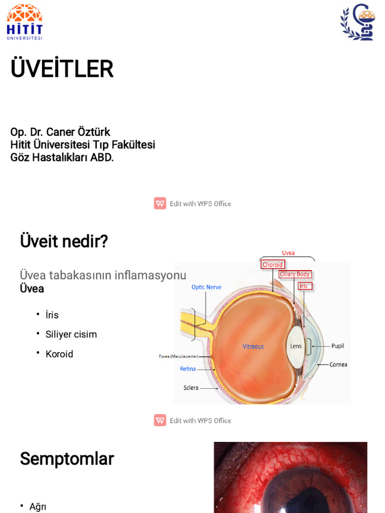 4 Uveit | PDF