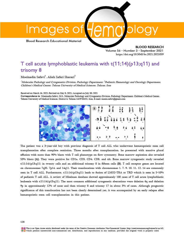 T Cell Acute Lymphoblastic Leukemia With t1114p13q | PDF | Cytogenetics ...