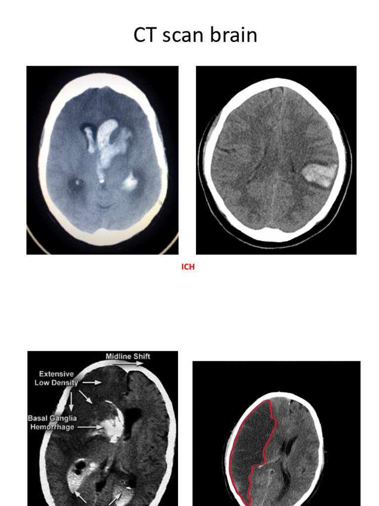 CT Scan | PDF