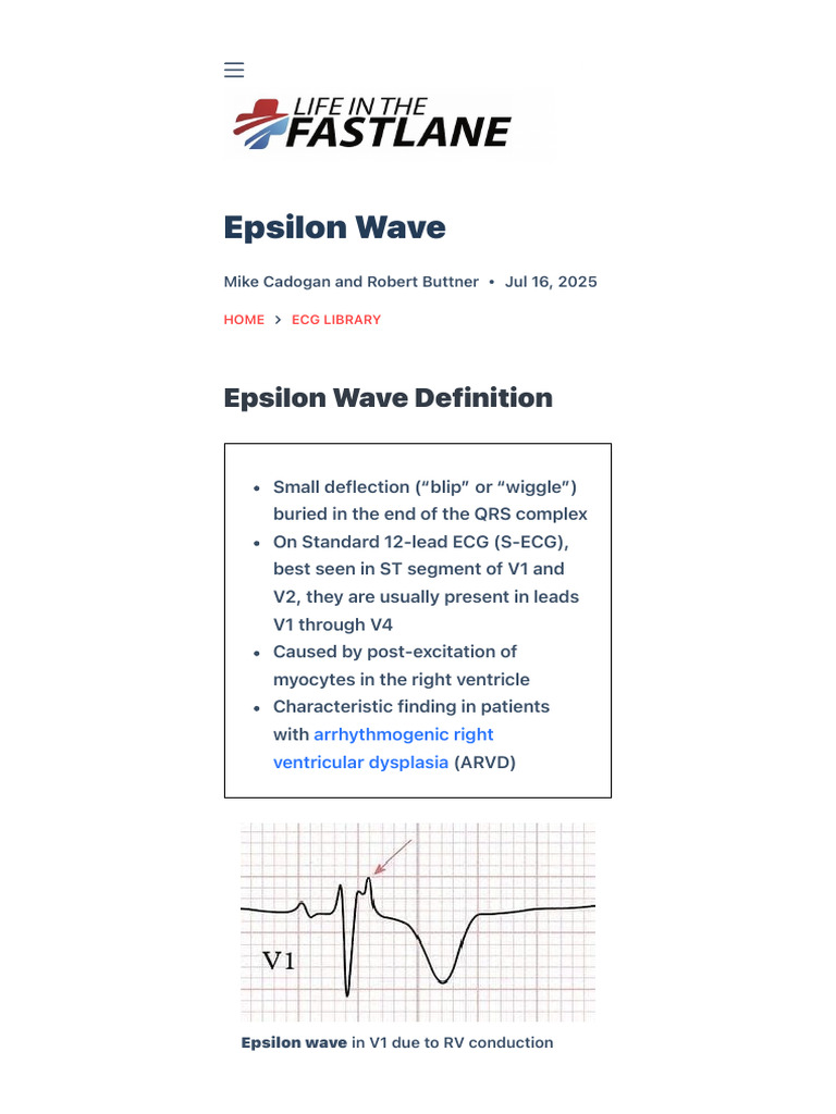 Epsilon Wave - LITFL Medical Blog - ECG Library Basics | PDF ...