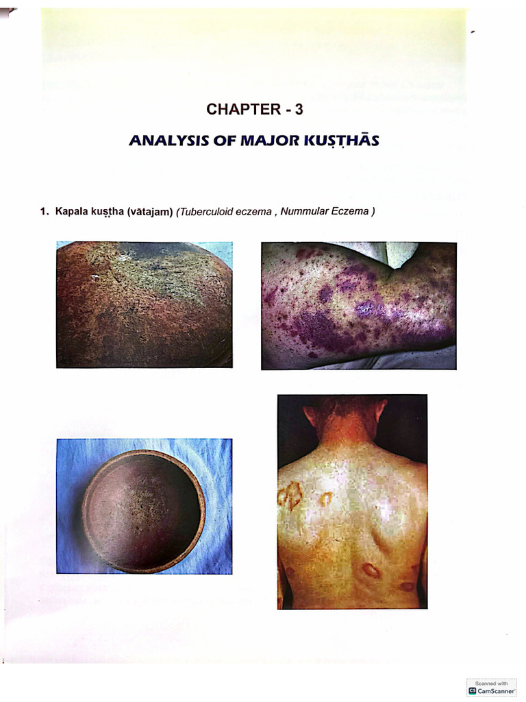 Analysis of Major Kustha | PDF