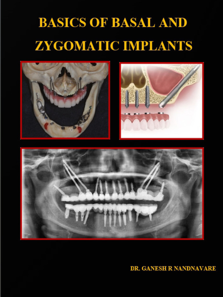 Basics of Basal and Zygomatic Implants, Dr. Ganesh r Nandnavare Dr ...
