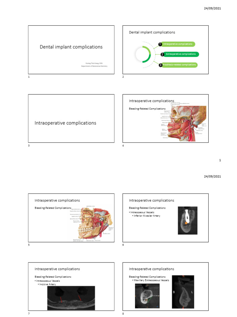 Dental Implant Complications | PDF | Dental Implant | Mouth