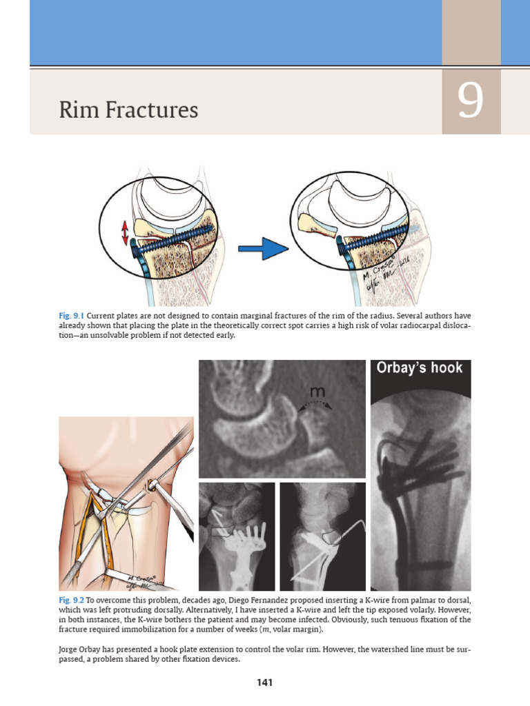 BC Atlas of Distal Radius Fractures 2018 9 Rim Fractures | PDF