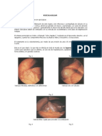 Tratamiento de pólipos vesiculares: colecistectomía o vigilancia