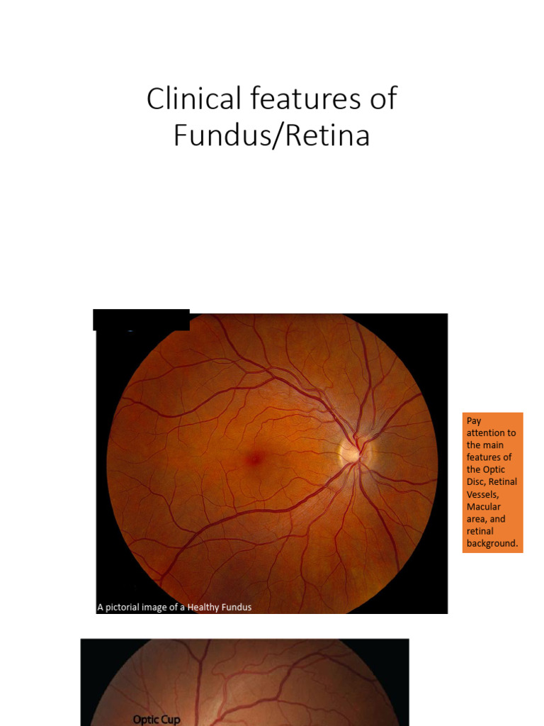 Clinical Features of Fundus(1) | PDF | Retina | Medical Specialties