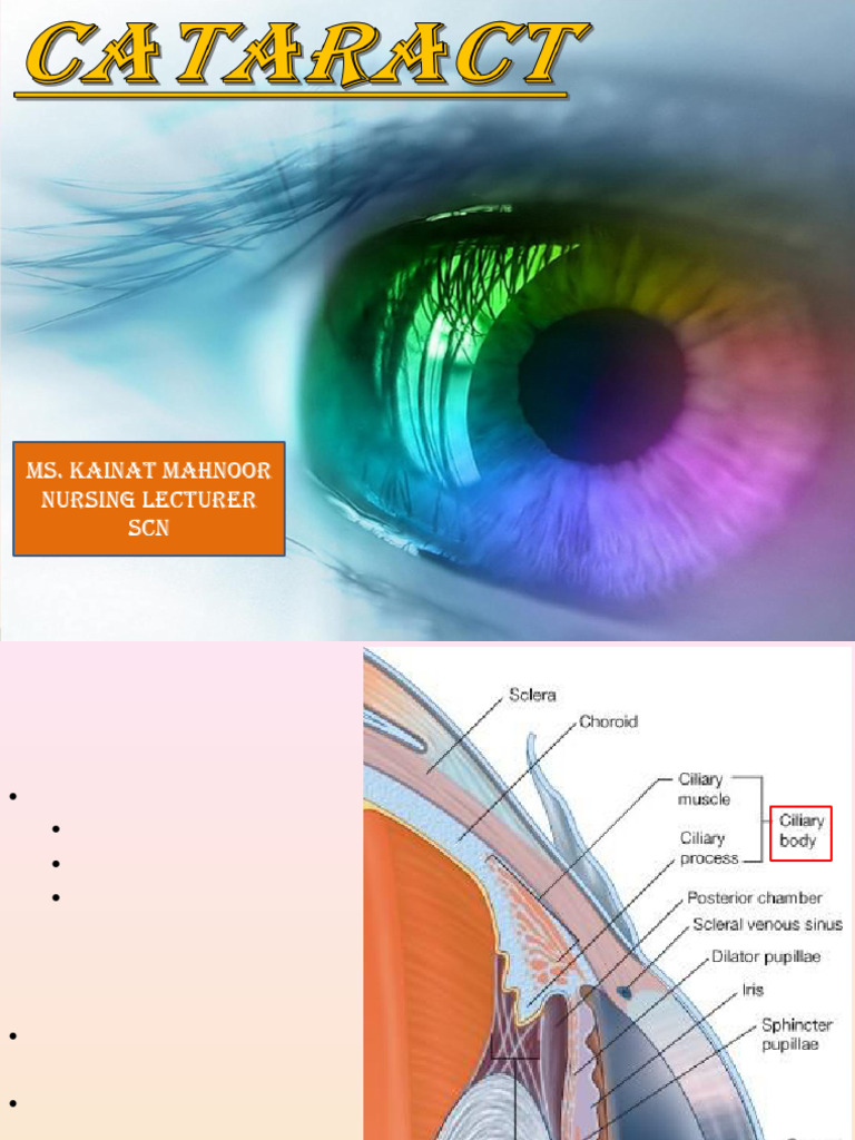 Cataract | PDF | Cataract | Ophthalmology