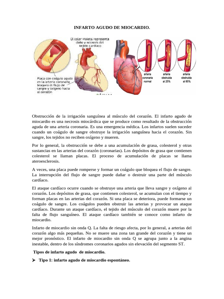 INFARTO AGUDO DE MIOCARDIO CON INTRO | PDF | Infarto de miocardio | Artería