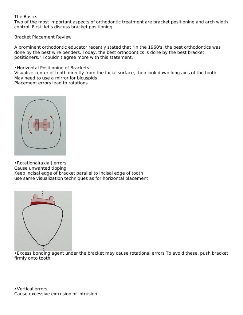 PDF) Comparison Between Laceback and Tie-back in Sliding Mechanics