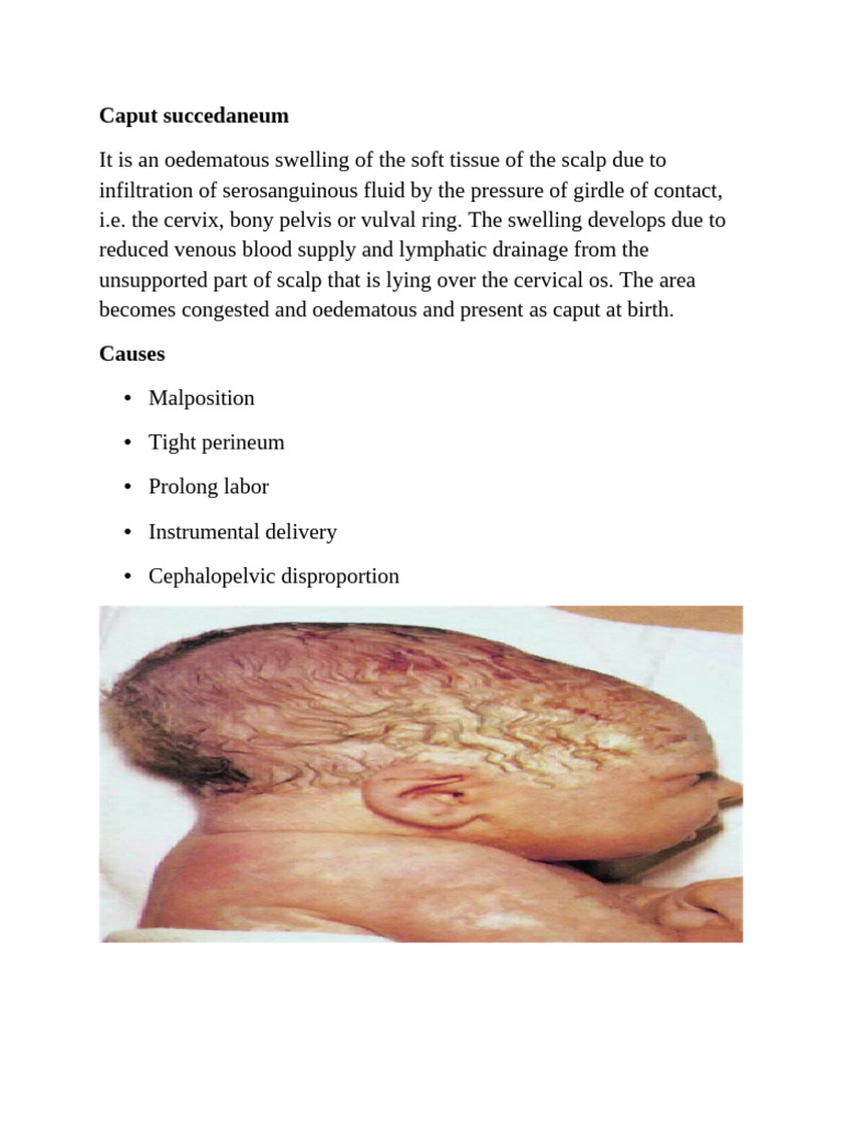 Caput Succedaneum Presentation | PDF