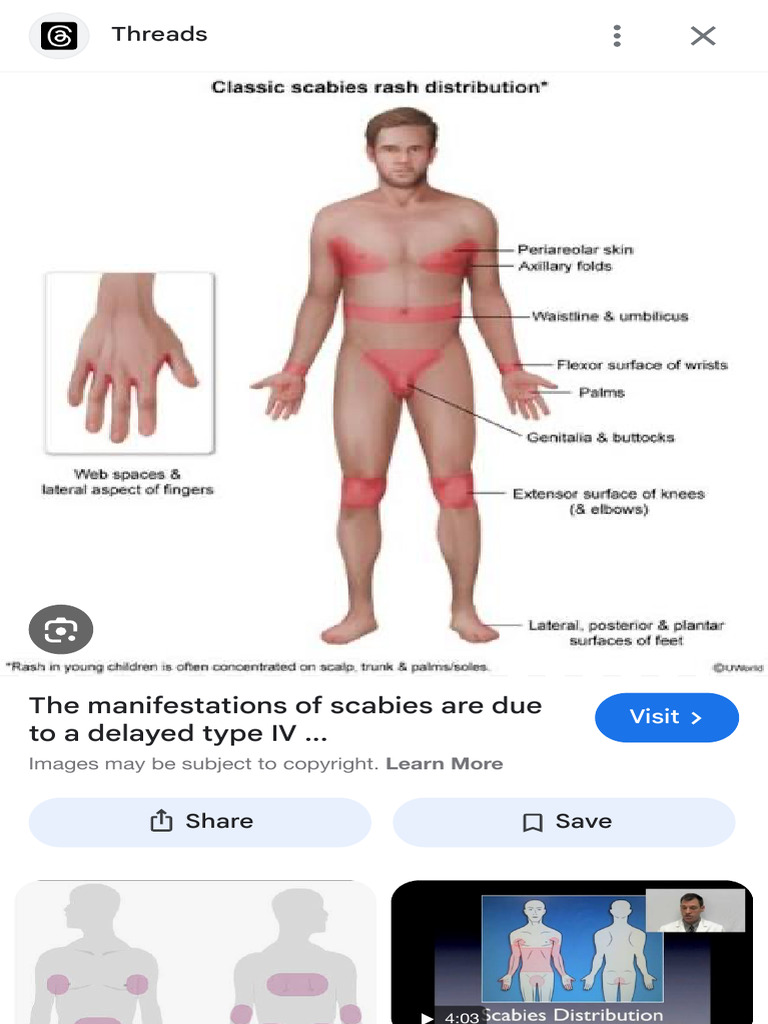 Scabies Rash Distribution - Google Search | PDF