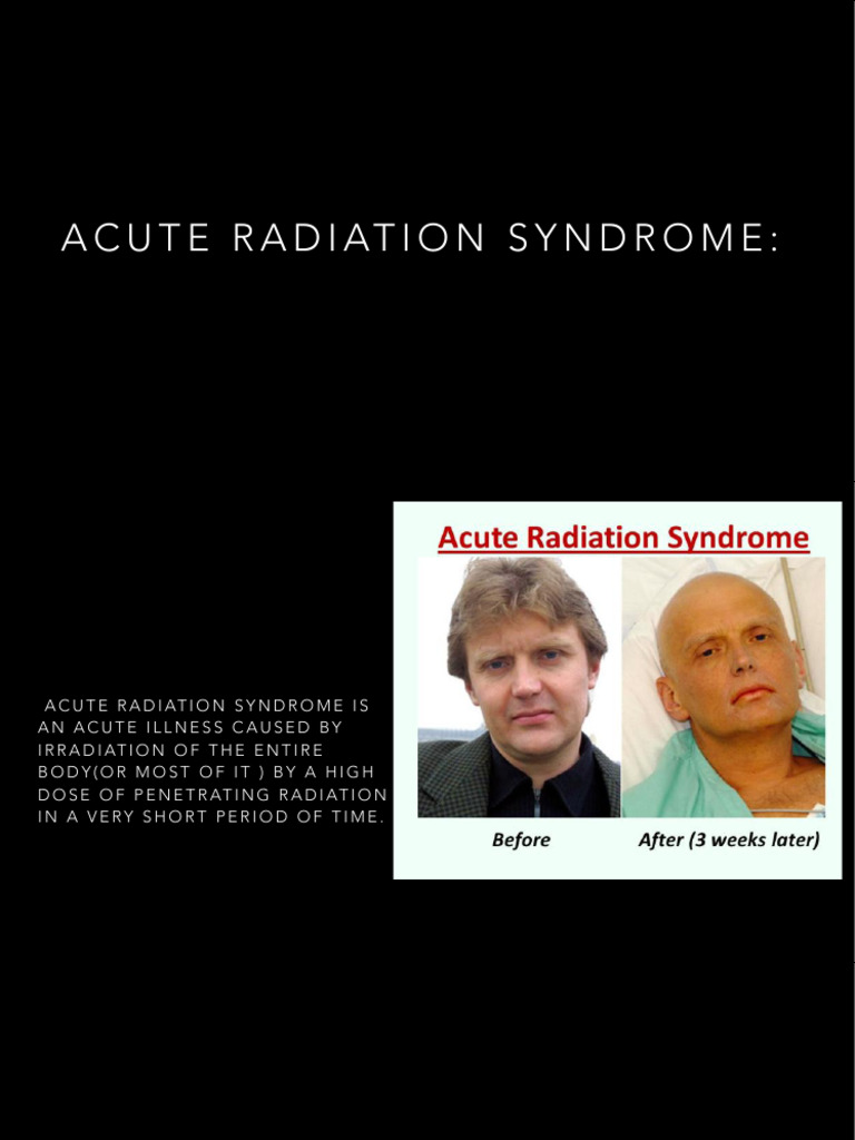 ARS Acute Radiation Syndrome | PDF | Acute Radiation Syndrome ...