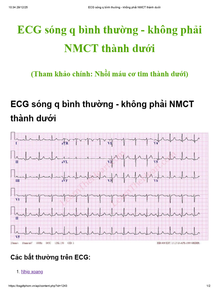 ECG Sóng q Bình Thường - Không Phải NMCT Thành Dưới | PDF
