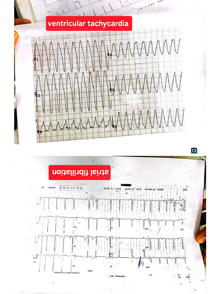 Ecg for Final Prof | PDF
