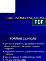 4 Carcinoma Escamoso