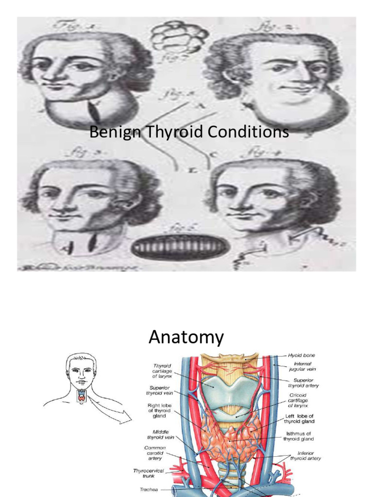 Benign Thyroid disorders | PDF