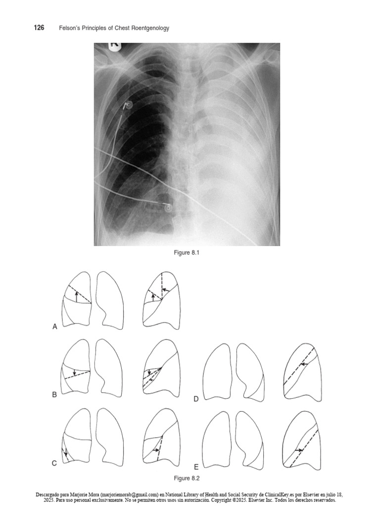 8. the Air Bronchogram Sign | PDF | Lung | Respiratory Diseases