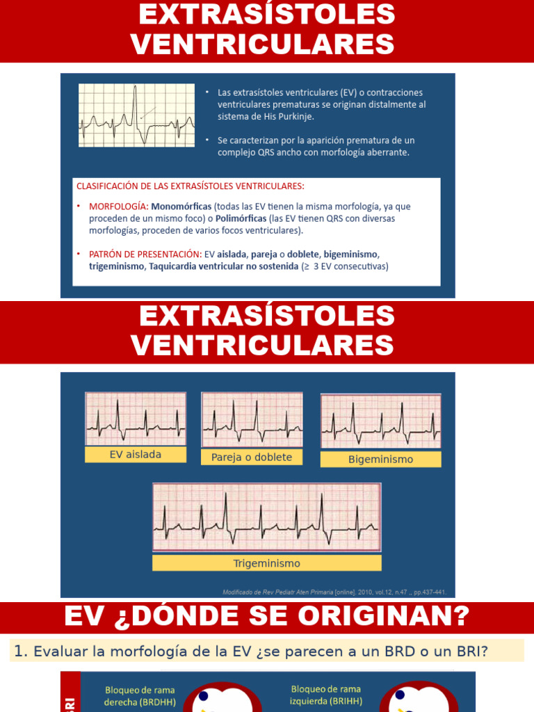 ARRITMIAS Extrasistoles Ventriculares | PDF