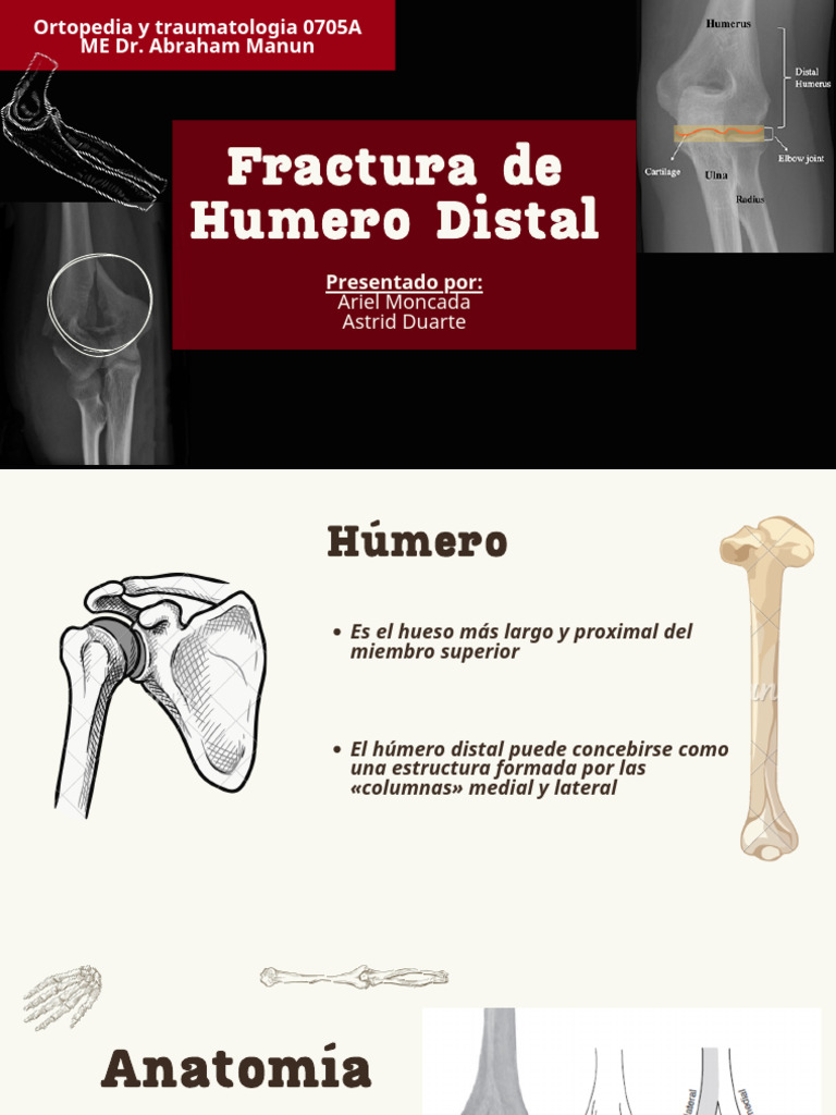 Fractura de Humero Distal | PDF | Codo | Sistema musculoesquelético