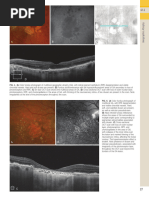 OCT Interpretation for Macula Diseases | PDF | Visual System | Diseases ...